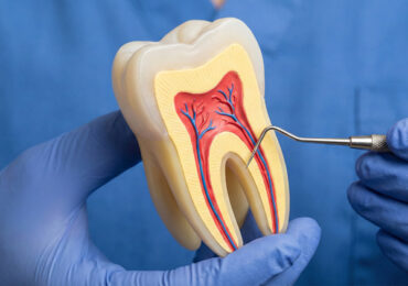 Root Canal Treatment citi dental nellore