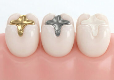 Dental Fillings citi dental nellore